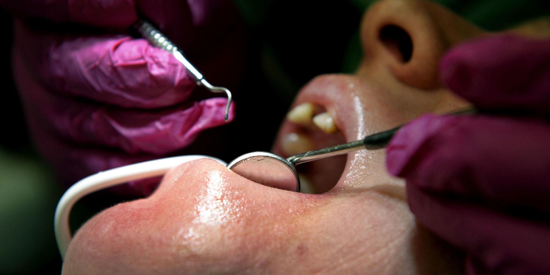 En tredjedel av de tänder som hade lagats med kompositfyllning direkt i munnen behövde lagas igen inom fem år. Arkivbild.