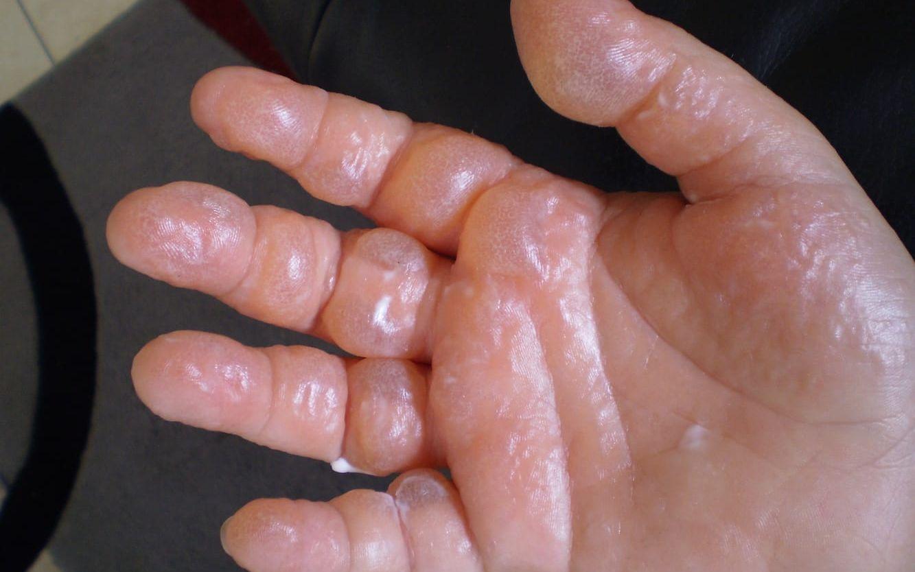 Hudsjukdomen phytophotodermatitis kan ge blåsbildning eller hudirritationer ibland i form av långsträckta partier.  Foto: Wikimedia Commons