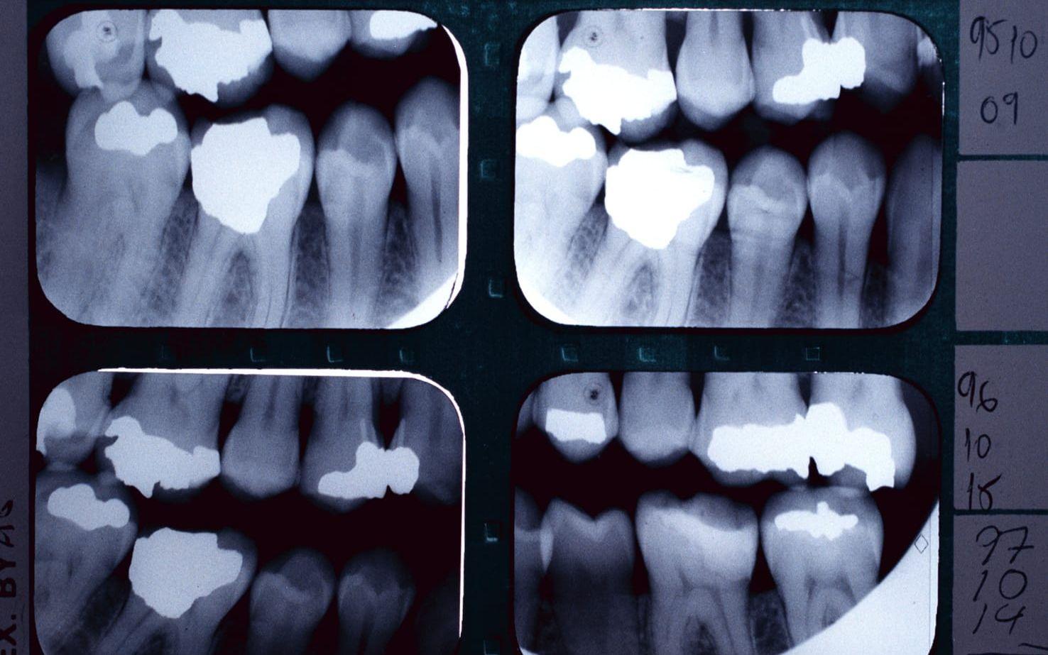 amalgam kvicksilverförbud